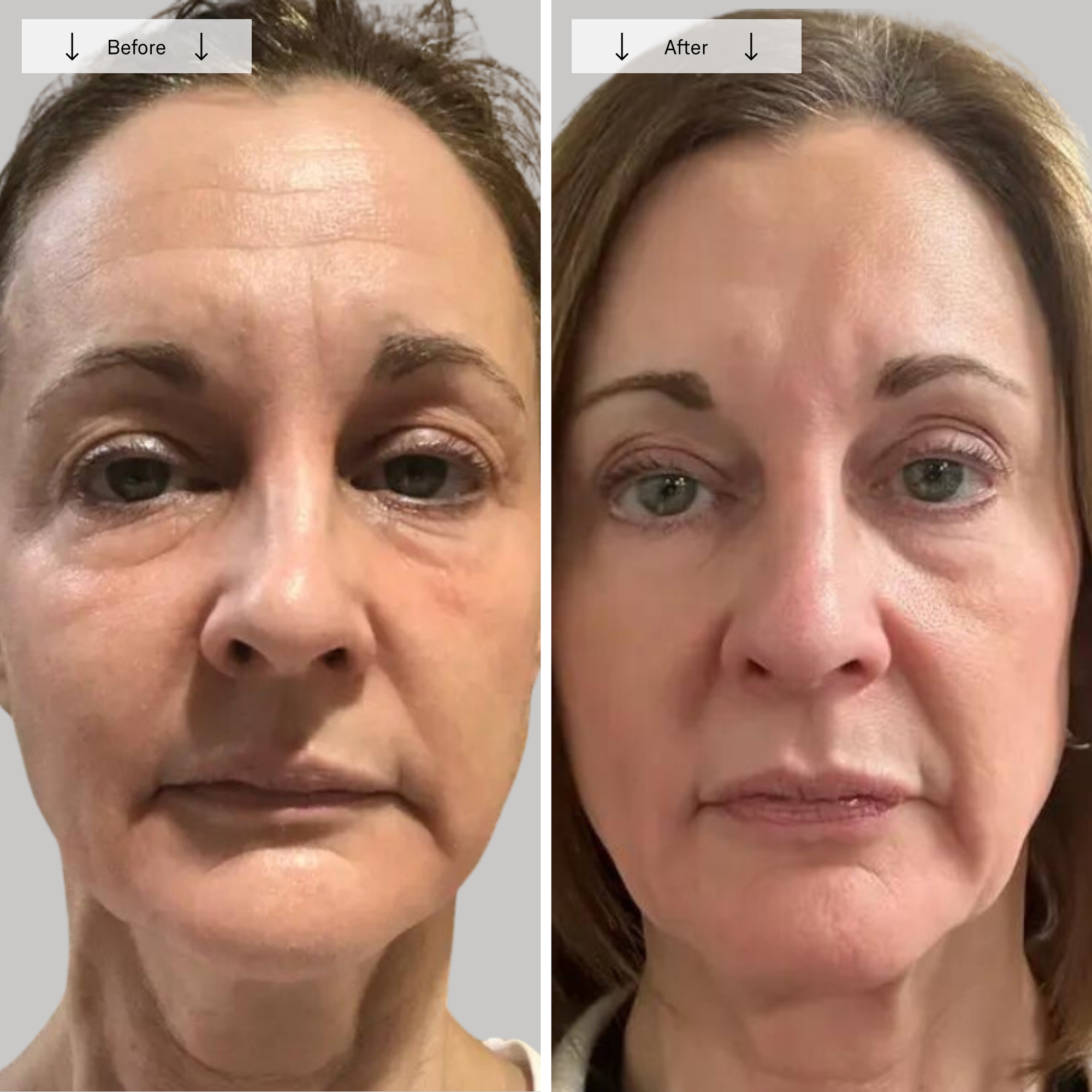 Omnilux Contour Face - Image 11