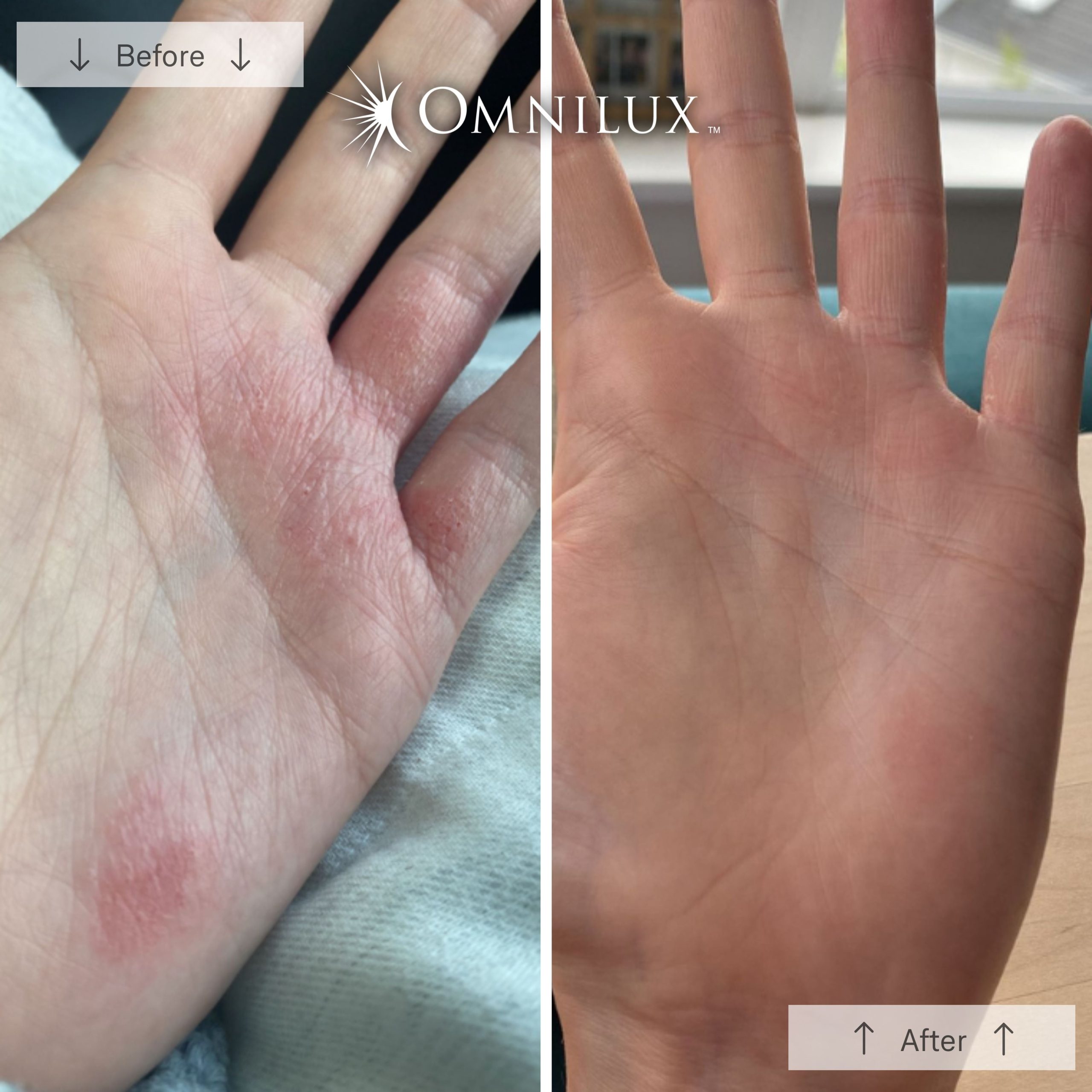 Omnilux Contour Glove - Image 8