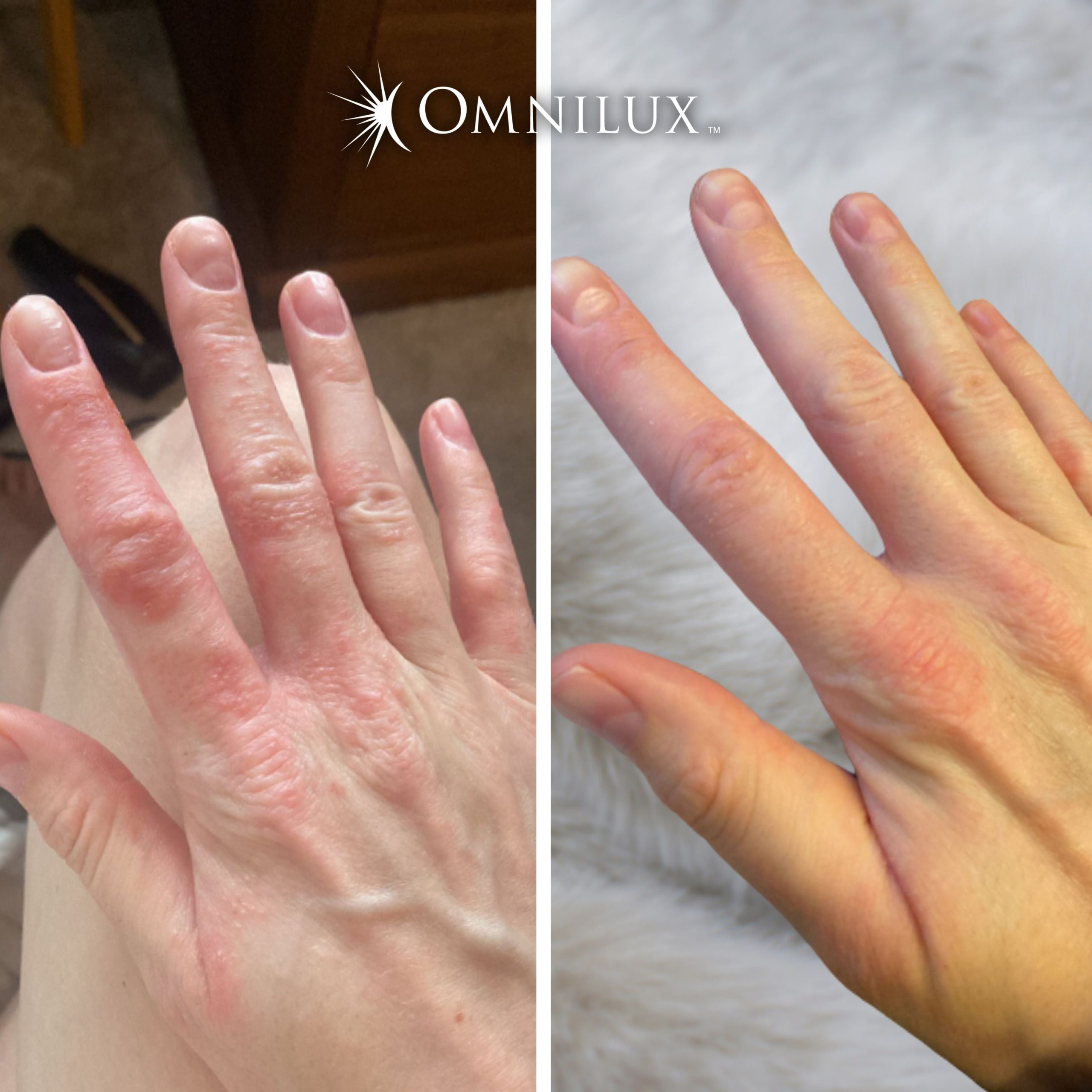 Omnilux Contour Glove - Image 10